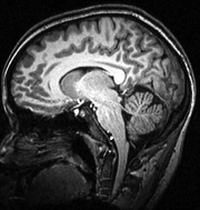 Vertical scan of brain