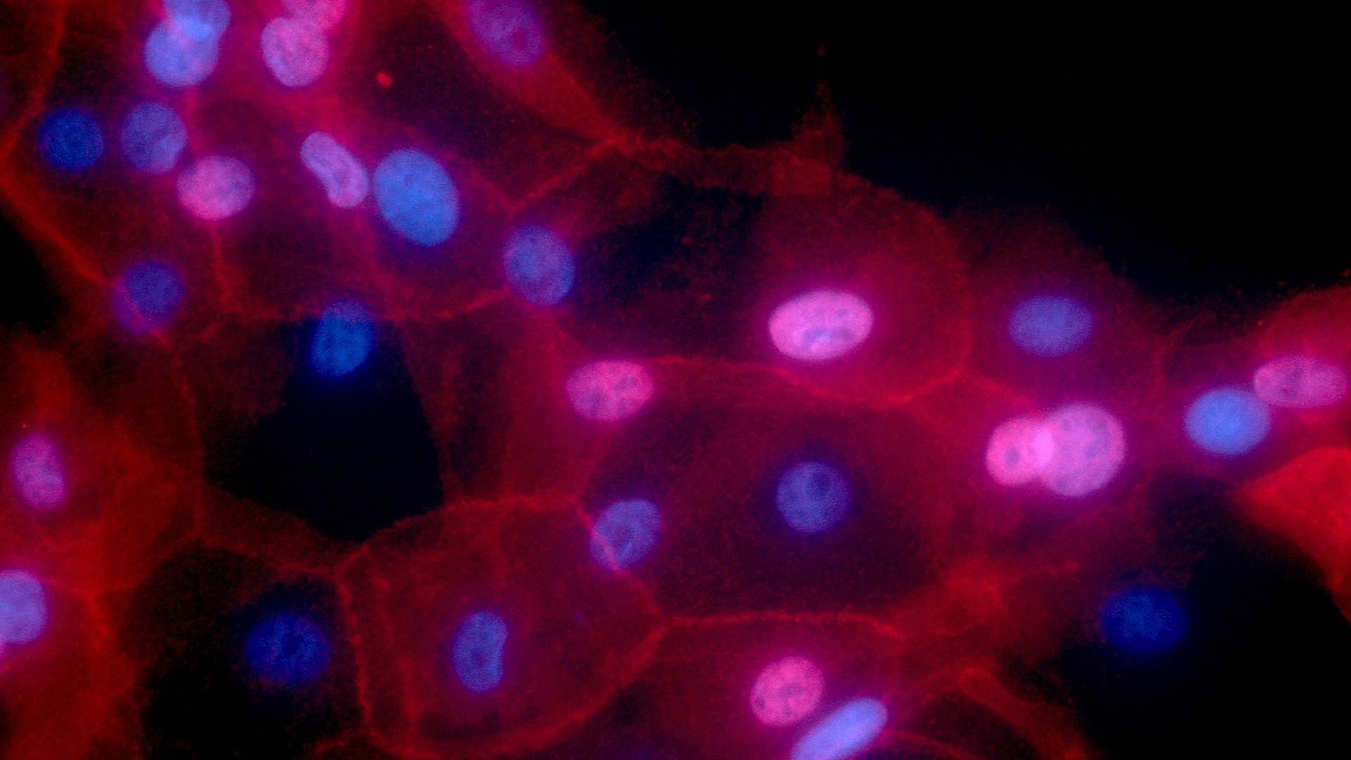 Breast cancer cells