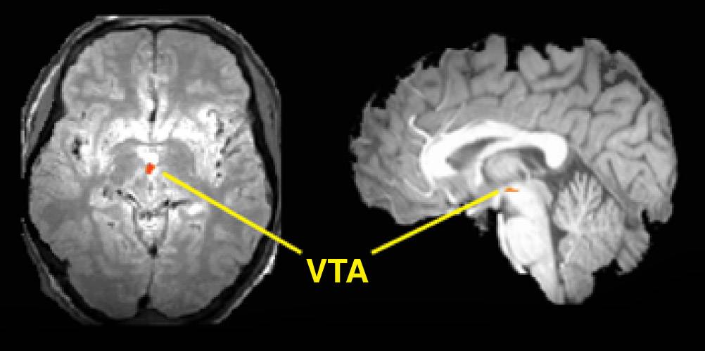 MRI scans showing increased activity in the stem