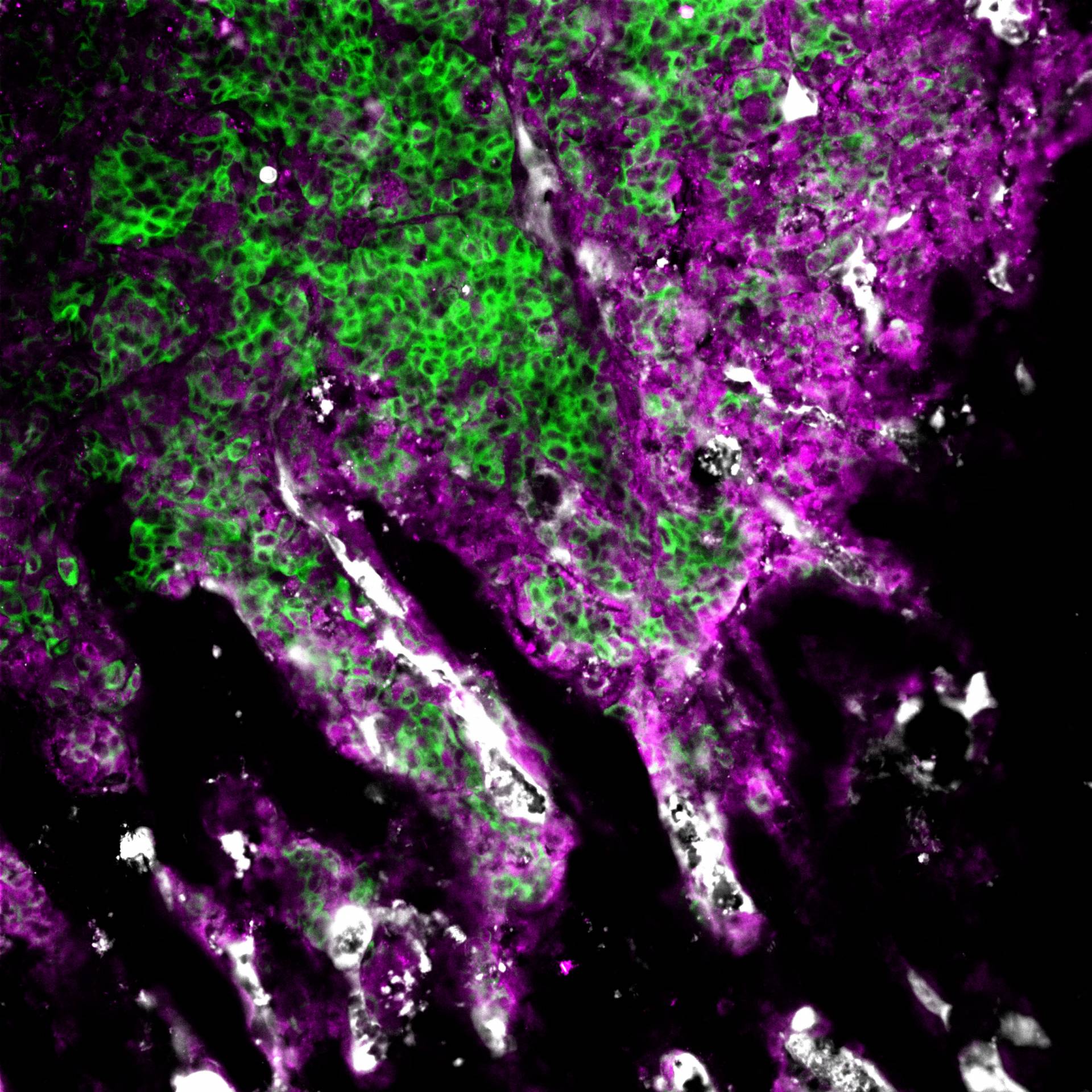 Microscope image showing brest cancer cells invading bone