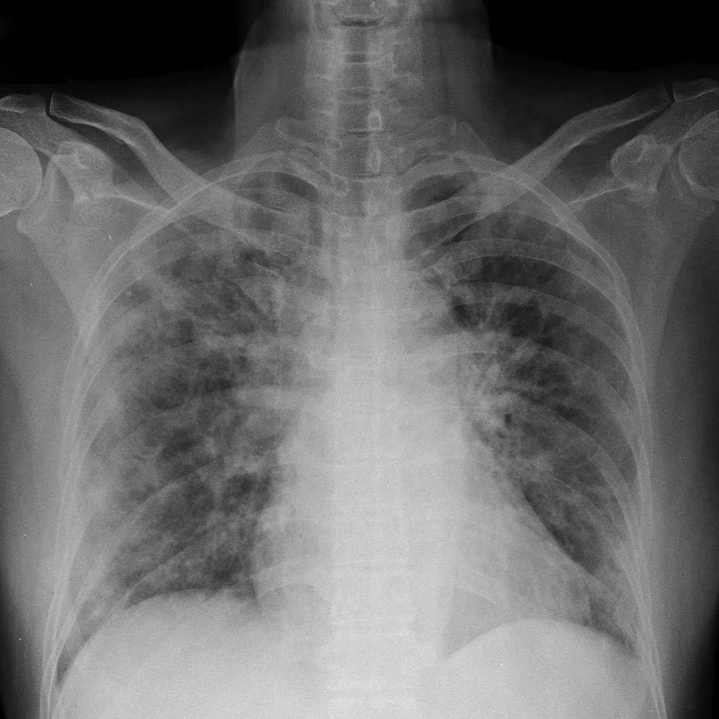 chest xray